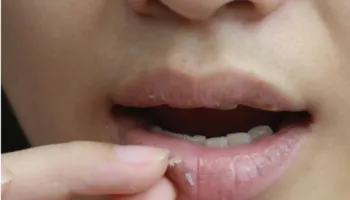 Çfarë të bëni kur ju plasariten buzët gjatë dimrit?