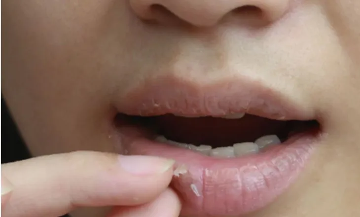 Çfarë të bëni kur ju plasariten buzët gjatë dimrit?