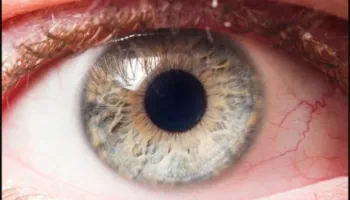 Epidemia e heshtur e verbërisë: Rastet e glaukomës po rriten, ndërsa miliona mbeten të padiagnostikuar