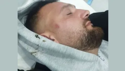 FOTO/ Protestuesi i opozitës denonocon Policinë: Më dhunuan dhe më thanë ik në spital se s’je mirë