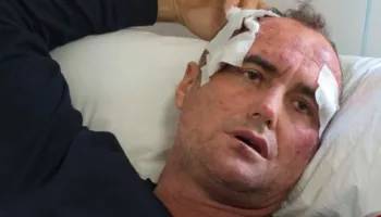 “I bëra motrës së tij një koment në Facebook”, punonjësi i policisë dhunon rëndë babë e bir në Fier