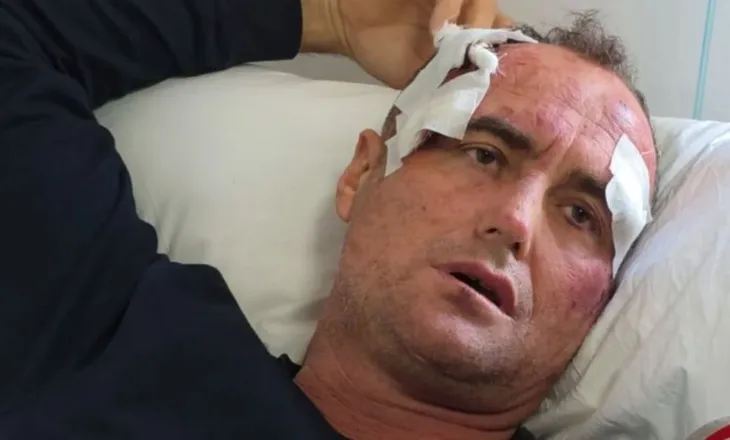 “I bëra motrës së tij një koment në Facebook”, punonjësi i policisë dhunon rëndë babë e bir në Fier