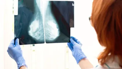 Revolucion në trajtimin e kancerit të gjirit, testi i studiuesve britanikë parashikon se cila terapi është më efektivja për pacientin