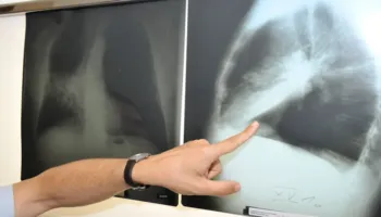 Shifrat alarmuese nga instituti prestigjioz: Një në dy persona do preket nga kanceri