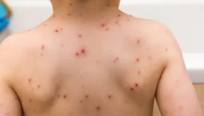 Shpërthen fruthi në SHBA, mbi 600 raste të konfirmuara në Karolinën e Jugut, alarm tek autoritetet shëndetësore