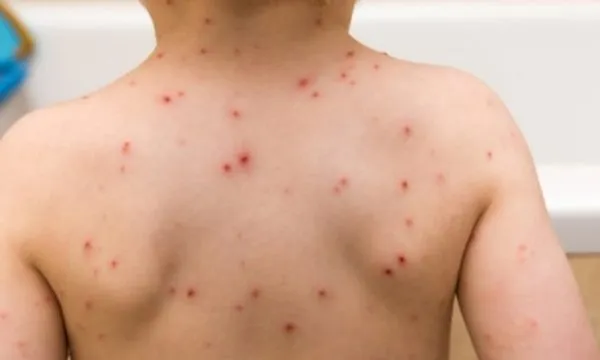 Shpërthen fruthi në SHBA, mbi 600 raste të konfirmuara në Karolinën e Jugut, alarm tek autoritetet shëndetësore