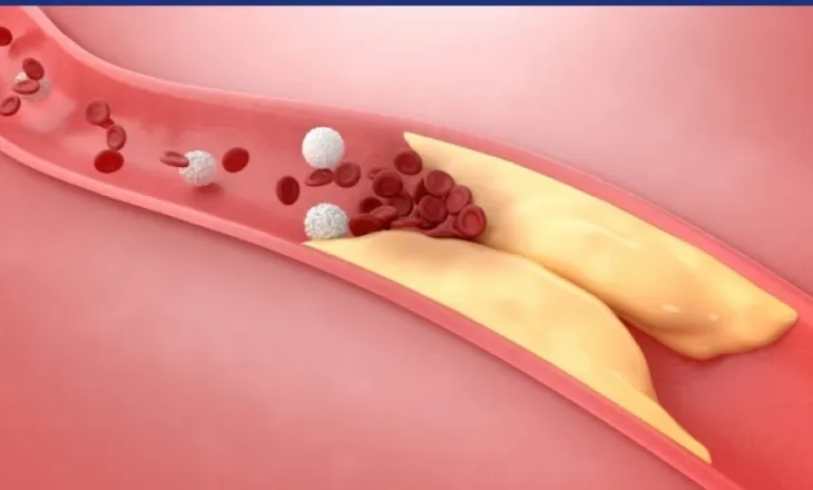 Si diagnostikohet dhe trajtohet ateroskleroza?