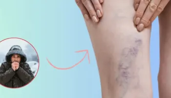 Si ndikon i ftohti dhe kushtet atmosferike në vena, cilat simptoma kërkojnë reagim urgjent