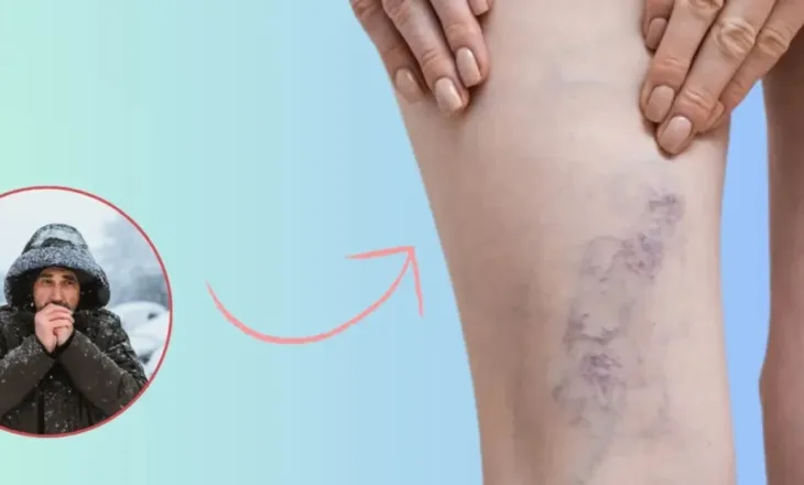 Si ndikon i ftohti dhe kushtet atmosferike në vena, cilat simptoma kërkojnë reagim urgjent