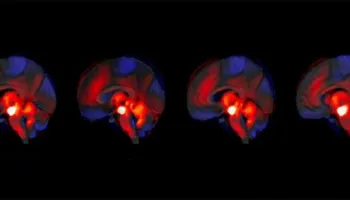 Skizofrenia: Roli i papritur i trurit të vogël