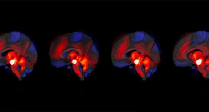 Skizofrenia: Roli i papritur i trurit të vogël