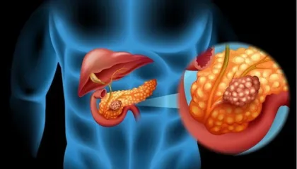 Studimi spanjoll jep njoftimin e rëndësishëm ndaj shërimit të kancerit të pankreasit