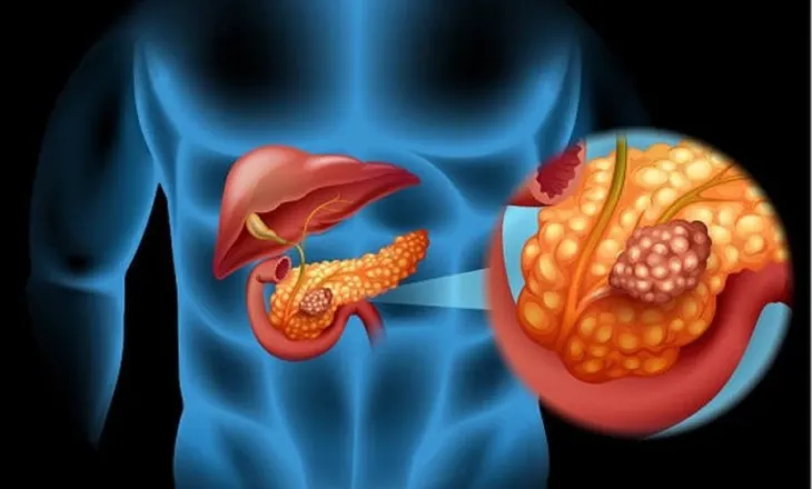 Studimi spanjoll jep njoftimin e rëndësishëm ndaj shërimit të kancerit të pankreasit