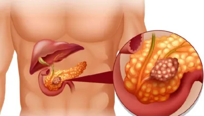 Studimi: Terapia me kombinim të trefishtë që eliminon tumoret pankreatike