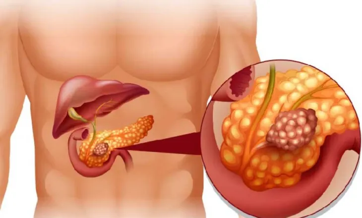 Studimi: Terapia me kombinim të trefishtë që eliminon tumoret pankreatike