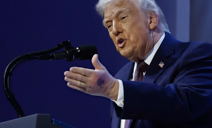 Trump shpjegon mavijosjen në dorën e majtë: Më ra…