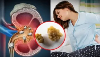 A varet shpeshtësia e gurëve në veshka nga niveli në gjak i vitamines D?