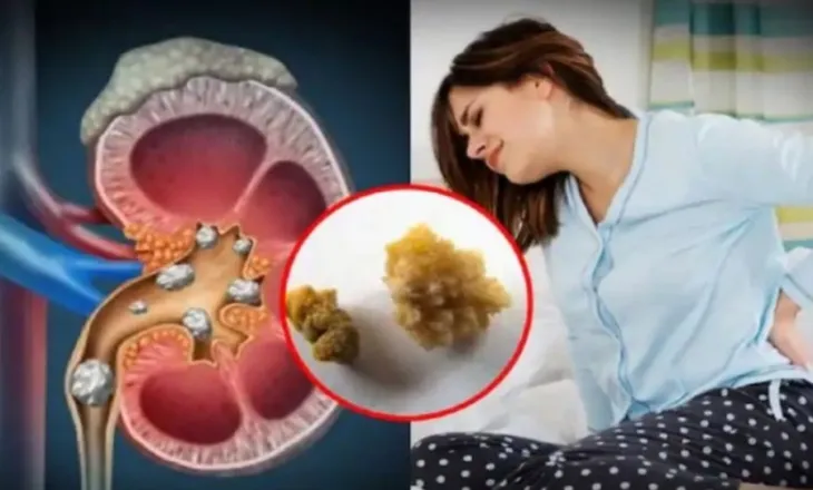 A varet shpeshtësia e gurëve në veshka nga niveli në gjak i vitamines D?