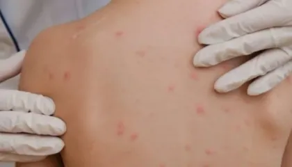 Alarm në SHBA, fruthi ‘shpërthen’ në disa shtete/ Mjekët: Njerëzit nuk po vaksinohen më