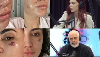 Denoncimi i gazetares/ Mjekja e promovuar nga Rama me dogji fytyren (fotot)