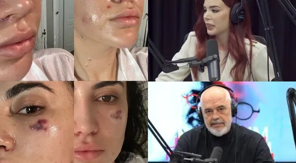 Denoncimi i gazetares/ Mjekja e promovuar nga Rama me dogji fytyren (fotot)