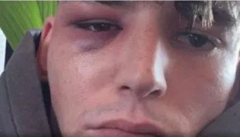 Dhunohet brutalisht arbitri homoseksual, propozoi partnerin në stadium pak ditë më parë