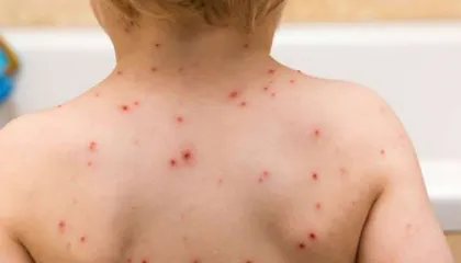 Fruthi në pediatri/ Ministria e Shëndetësisë e mohon, por OBSH heq Shqipërinë nga lista e vendeve pa këtë sëmundje