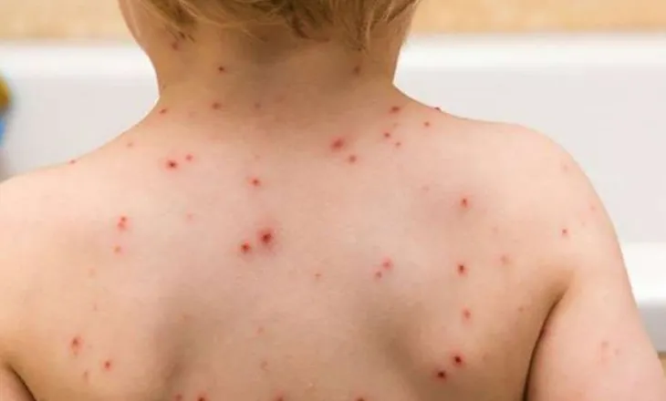 Fruthi në pediatri/ Ministria e Shëndetësisë e mohon, por OBSH heq Shqipërinë nga lista e vendeve pa këtë sëmundje