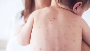 Instituti i Shëndetit Publik apelon për vaksinimin e fëmijëve kundër fruthit