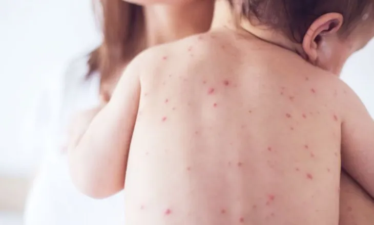 Instituti i Shëndetit Publik apelon për vaksinimin e fëmijëve kundër fruthit