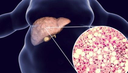 Mëlçia e dhjamosur, sëmundja e heshtur që po prek miliona njerëz
