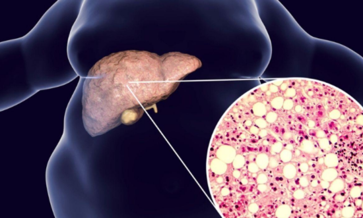 Mëlçia e dhjamosur, sëmundja e heshtur që po prek miliona njerëz