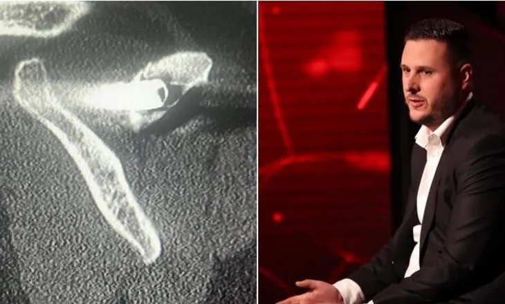 “Na hodhën në kamionin me viktima”/ I mbijetuari i masakrës së Suharekës rrëfen tmerrin: Kam 27 vite me plumb në trup