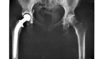 Protezat moderne të legenit mund të zgjasin të paktën 25 vjet