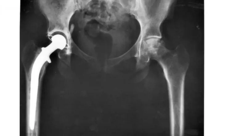 Protezat moderne të legenit mund të zgjasin të paktën 25 vjet