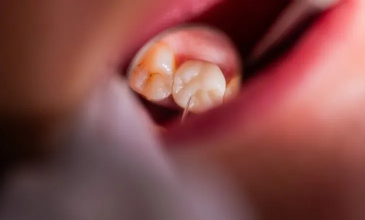 Pse dhëmbi dhemb më shumë natën – dhe si ta trajtoni atë