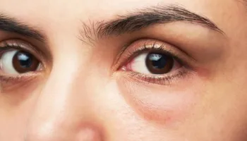 Qeskat nën sy, si t’i parandaloni dhe largoni