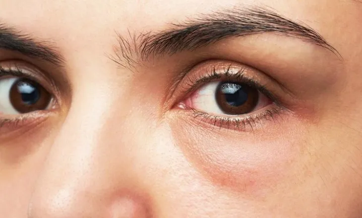 Qeskat nën sy, si t’i parandaloni dhe largoni