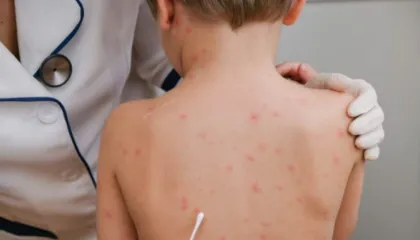 Vaksina e fruthit te fëmijët, mjeku tregon pasojat: Çfarë ndodh nëse pacienti ka ndërlikime