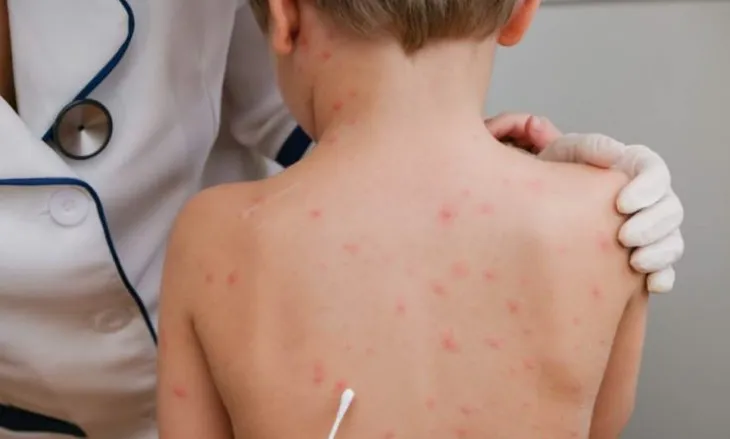 Vaksina e fruthit te fëmijët, mjeku tregon pasojat: Çfarë ndodh nëse pacienti ka ndërlikime