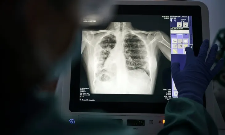 Agjencitë shëndetësore: Evropa humbet 1 nga 5 raste të tuberkulozit, ndërsa rezistenca ndaj ilaçeve rritet