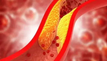 Gabimet më të zakonshme që ndikojnë te kolesteroli