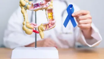 Kanceri kolorektal, alarm për të rinjtë: Rriten rastet dhe vdekshmëria nën moshën 50 vjeç