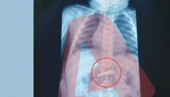 Moment paniku/ 3-vjeçari luan me briskun dhe e gëlltit aksidentalisht