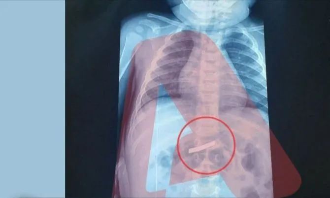 Moment paniku/ 3-vjeçari luan me briskun dhe e gëlltit aksidentalisht