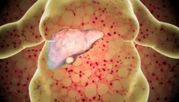 Njihuni me MASLD: sëmundja që sulmon mëlçinë në heshtje dhe rrit rrezikun për diabet dhe zemër