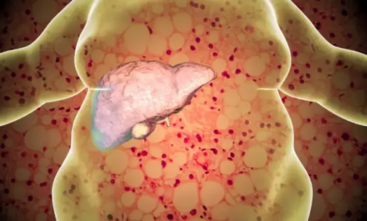 Njihuni me MASLD: sëmundja që sulmon mëlçinë në heshtje dhe rrit rrezikun për diabet dhe zemër