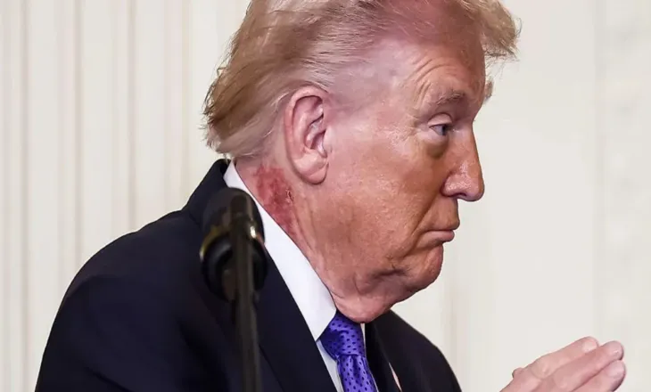 Njolla e madhe e kuqe në qafën e Trump, i tremb amerikanët më shumë se Irani