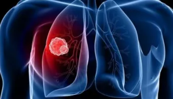 Raporti i OBSH: Tuberkulozi mbetet kërcënim serioz në Europë! 1 në 5 raste nuk raportohet