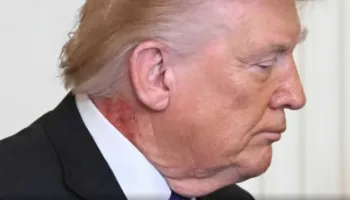 Spekulimet për shëndetin e Trump pas njollës së kuqe në qafën e tij, reagon mjeku personal i presidentit: Mund të zgjasë disa javë, po e trajton me një krem që…